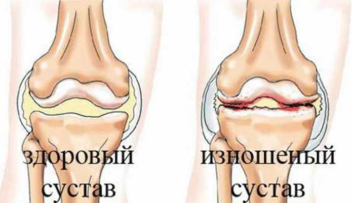 Проблема звуков и болей в коленях