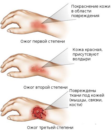 Несколько способов согреть кожу