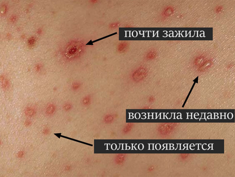 Симптомы и внешний вид ветрянки